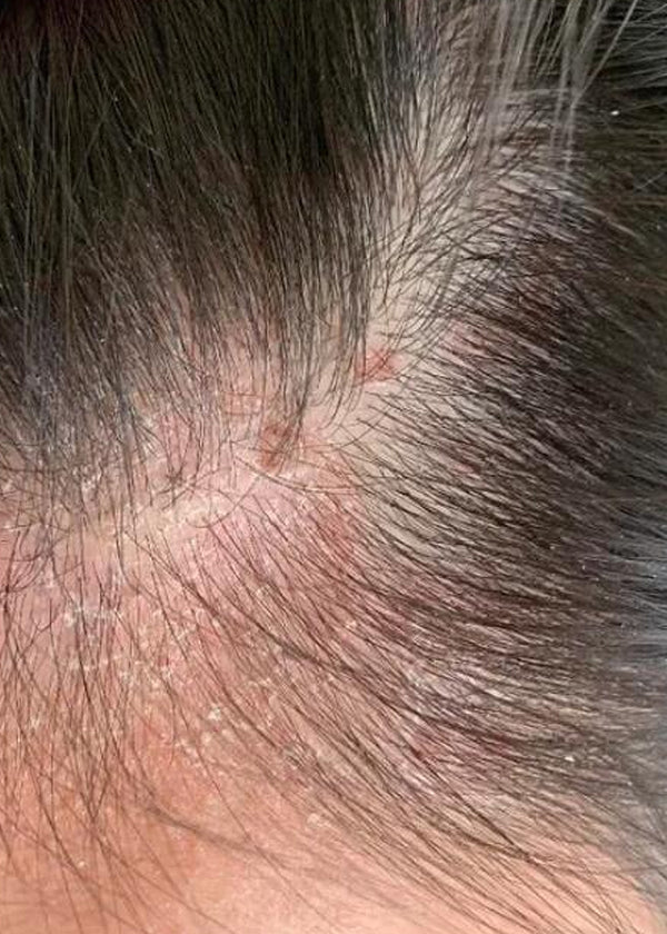 Sensitive scalp