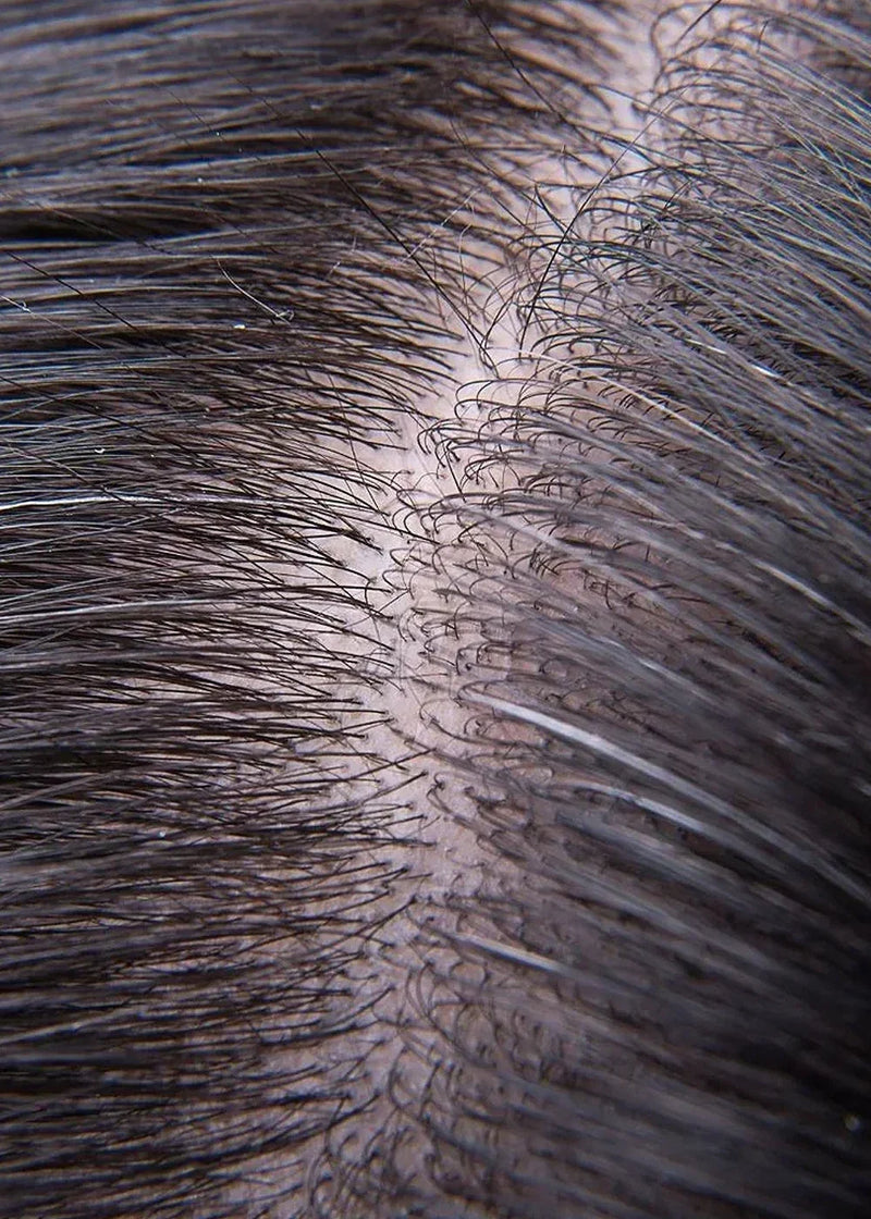 Hair Fall