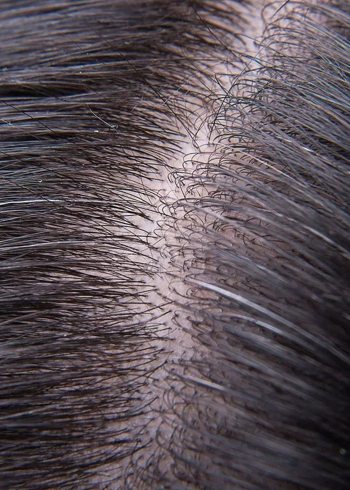 oily Scalp