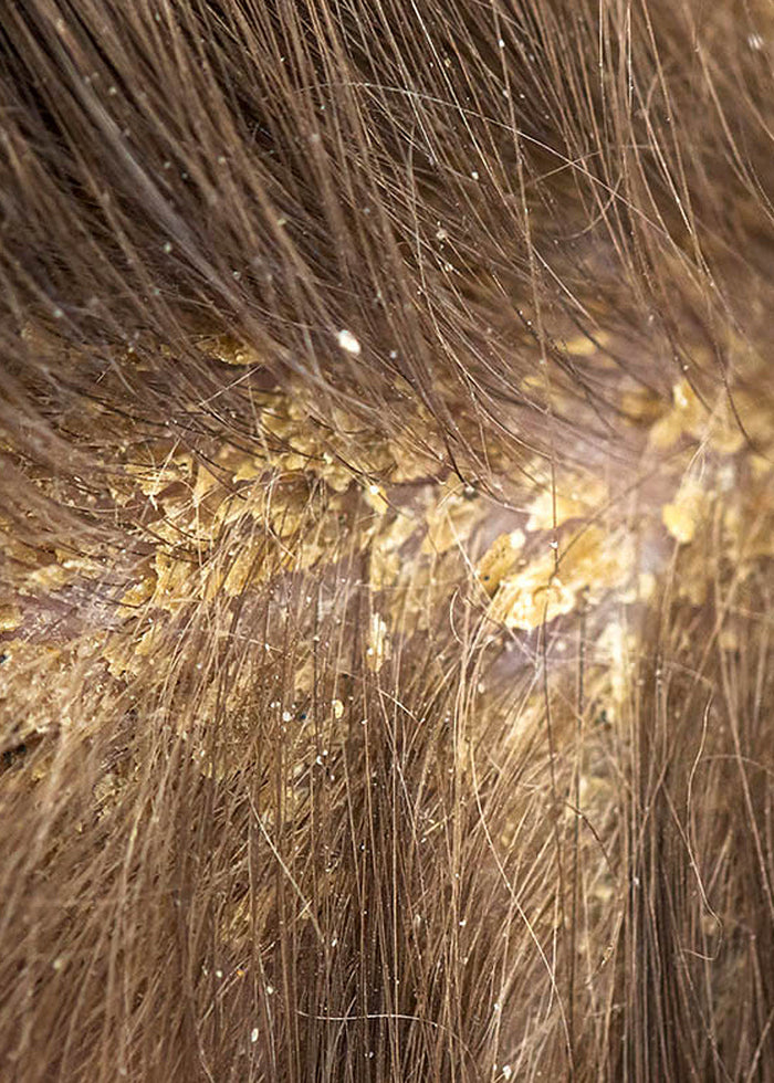 dandruff