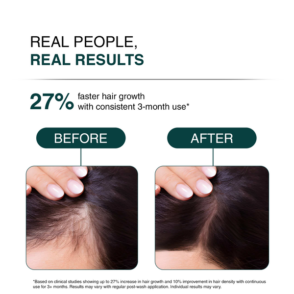 Hair Thinning Control Scalp Essence | Revive (R3) Scalp Essence  For Mild Hair Loss & Growth