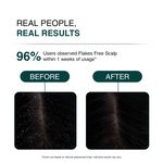 Before-and-after comparison graphic showing scalp clarity and hair growth results, with text reading 'REAL PEOPLE, REAL RESULTS' and '96% Users observed Flakes Free Scalp within 1 weeks of usage'.