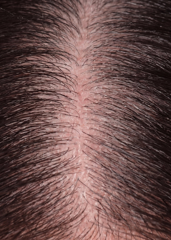 Dry scalp