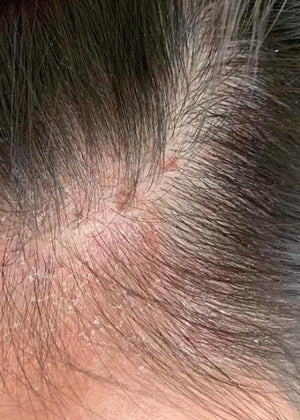 SENSITIVE SCALP