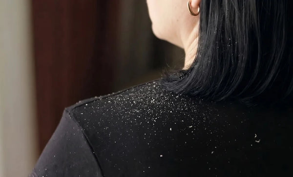 Dandruff and flaky scalp